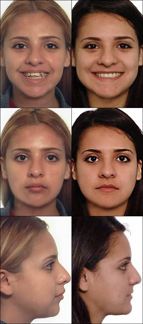 Surgical orthodontics case 2: facial photos before and after treatment