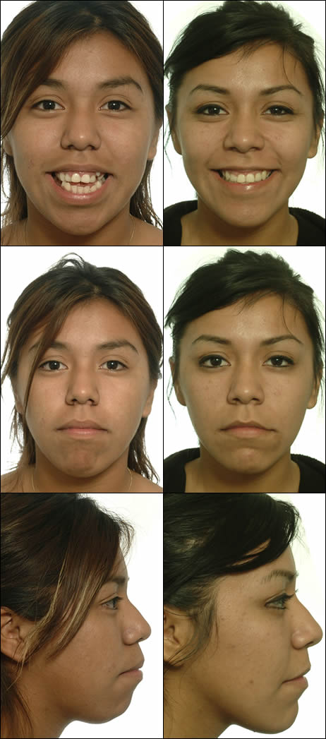 Surgical orthodontics case 3: facial photos before and after treatment