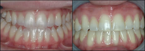Surgical orthodontics case 1: teeth before and after treatment
