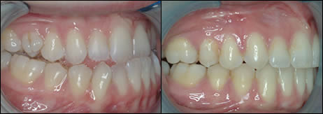 Surgical orthodontics case 1: teeth before and after treatment
