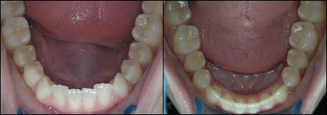 Surgical orthodontics case 1: teeth before and after treatment