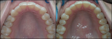 Surgical orthodontics case 1: teeth before and after treatment