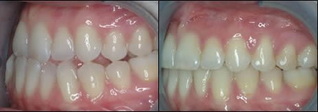 Surgical orthodontics case 1: teeth before and after treatment