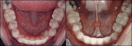 Surgical orthodontics case 2: teeth before and after treatment