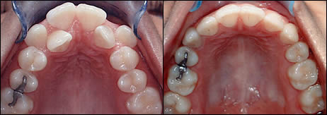 Surgical orthodontics case 2: teeth before and after treatment