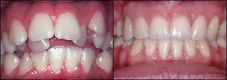 Surgical orthodontics case 2: teeth before and after treatment