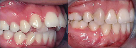 Surgical orthodontics case 2: teeth before and after treatment