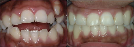 Surgical orthodontics case 3: teeth before and after treatment