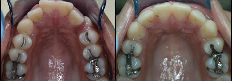 Surgical orthodontics case 3: teeth before and after treatment