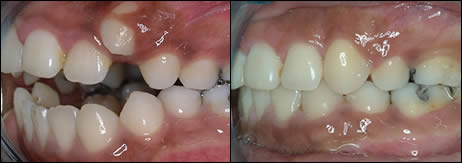Surgical orthodontics case 3: teeth before and after treatment